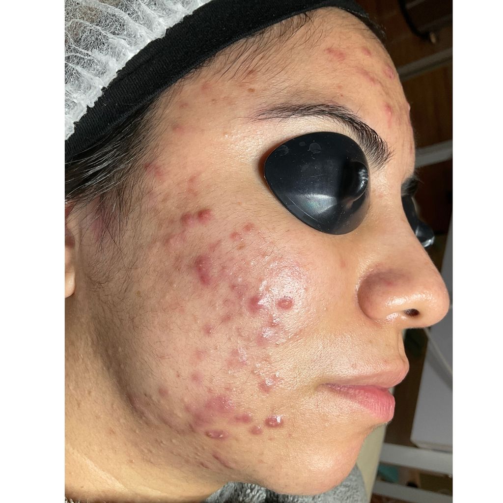 We see clients with mild, moderate and severe acne