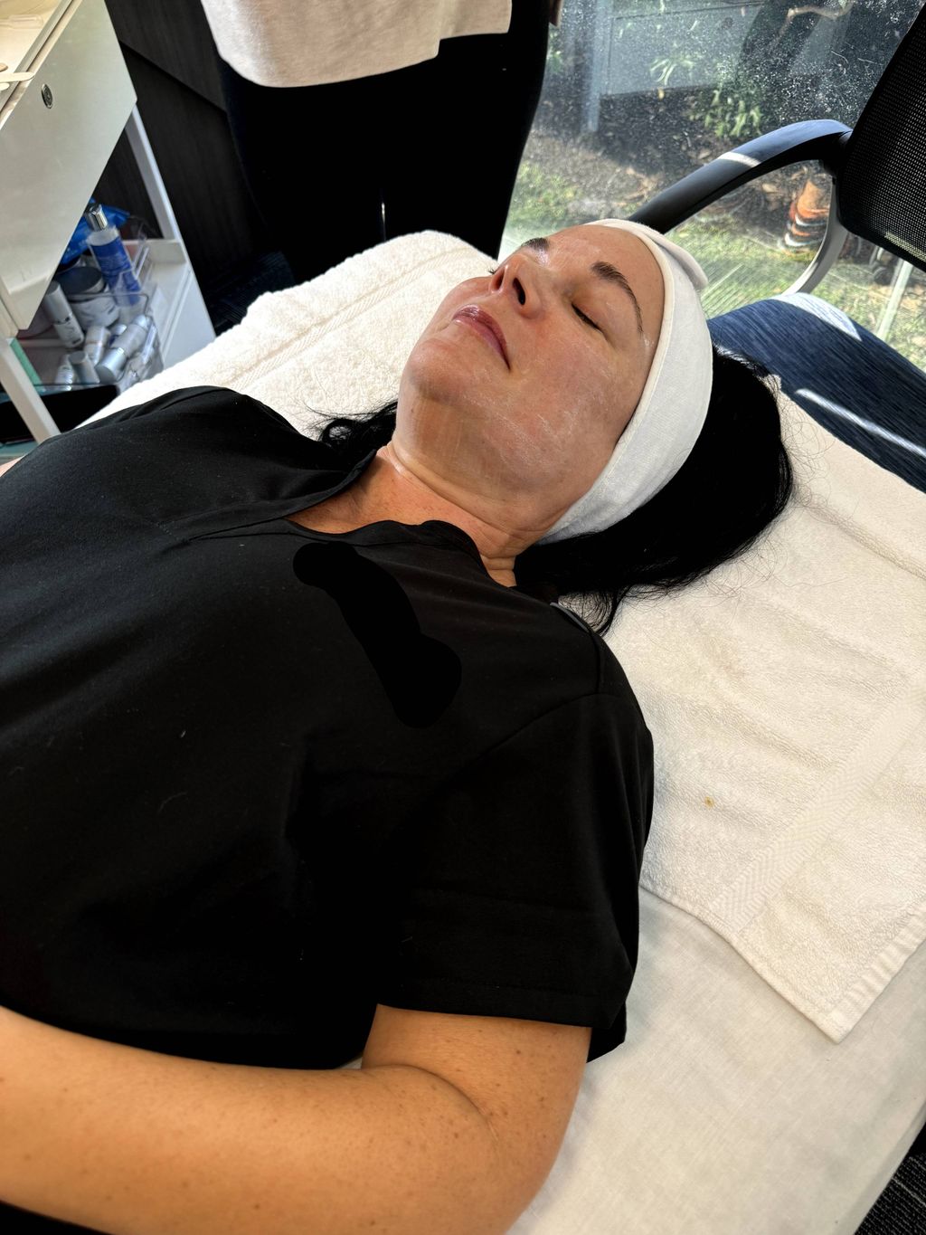 chemical peel frosting