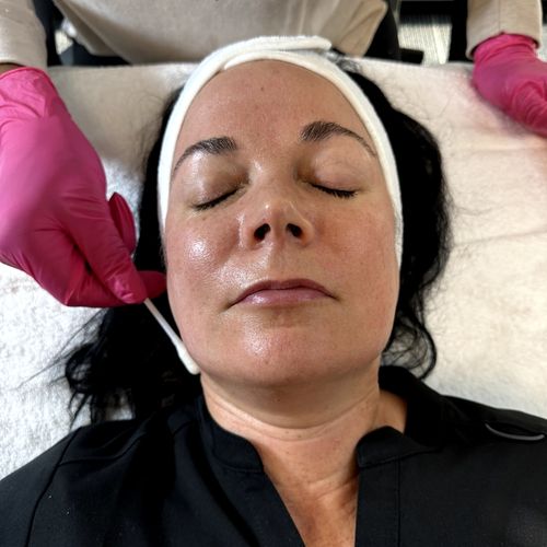 chemical peel application 