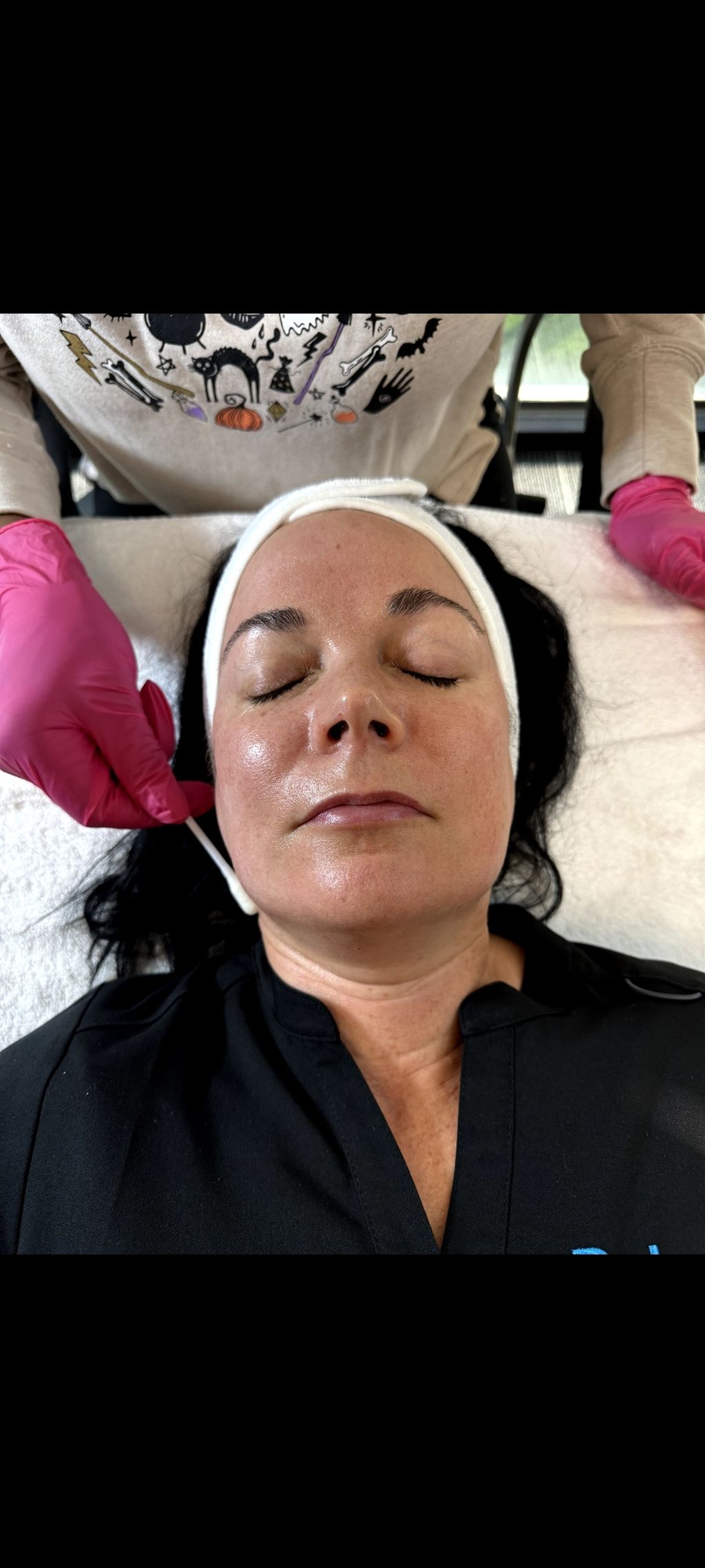 chemical peel application 