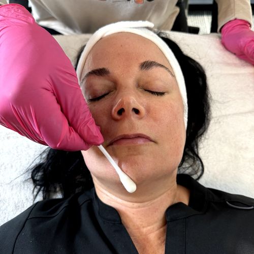 Chemical Peel application 