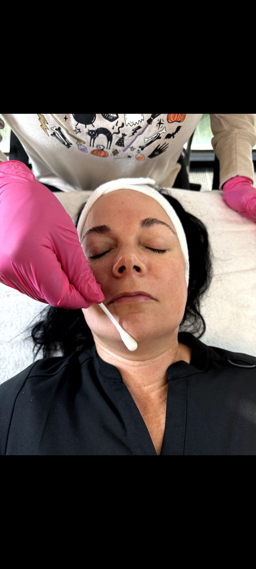 Chemical Peel application 