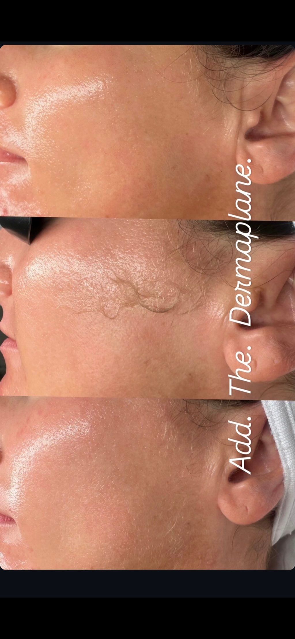 Dermaplaning 