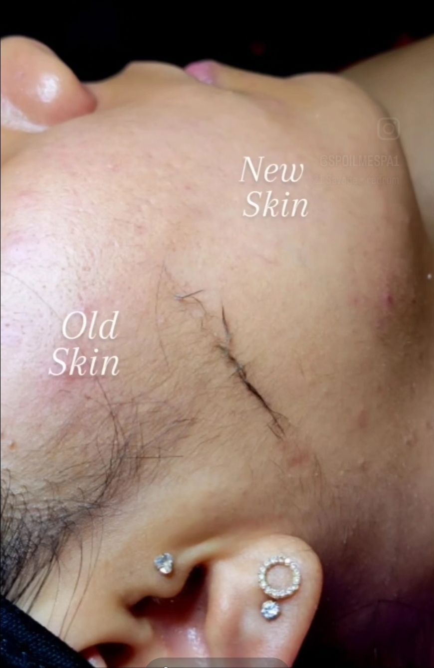 Dermaplane 