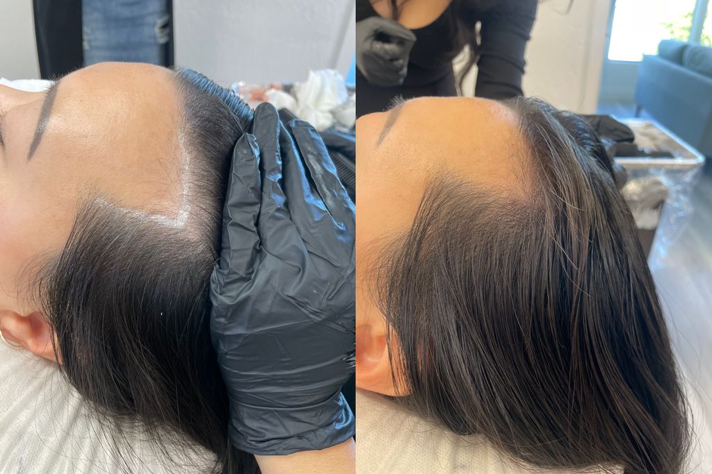 Before and after hair density treatment.