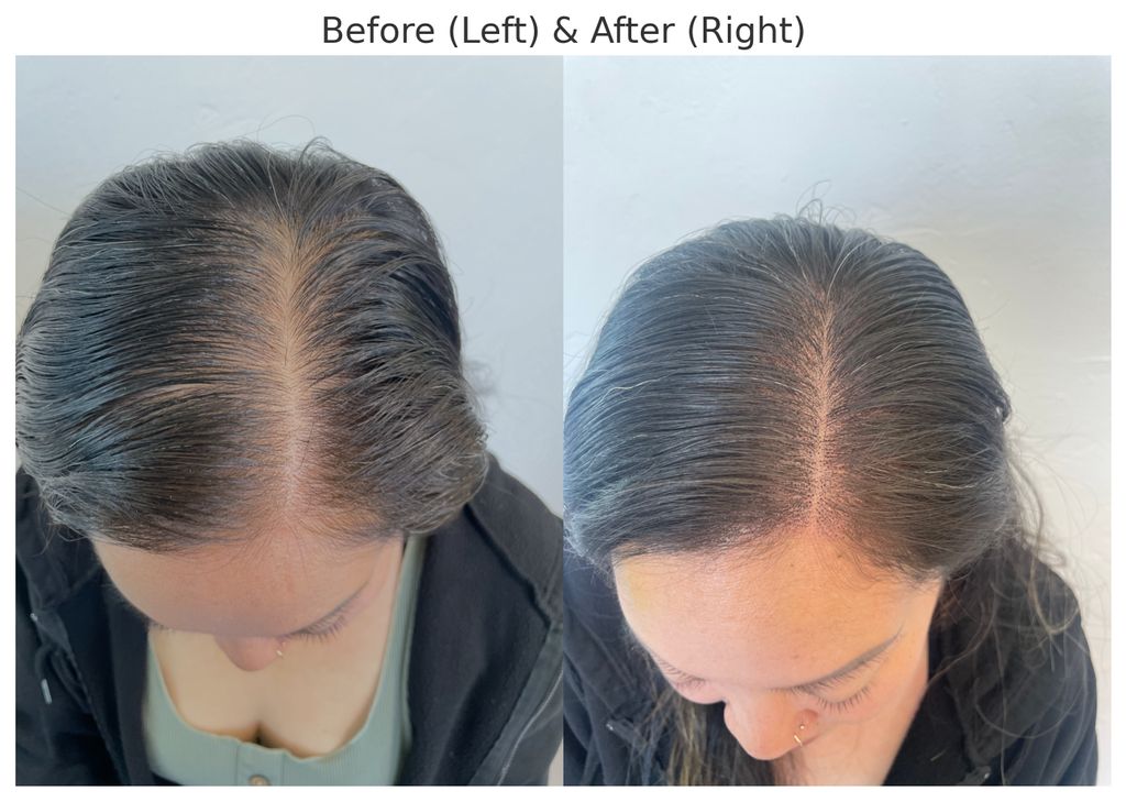 Before and after hair density treatment.