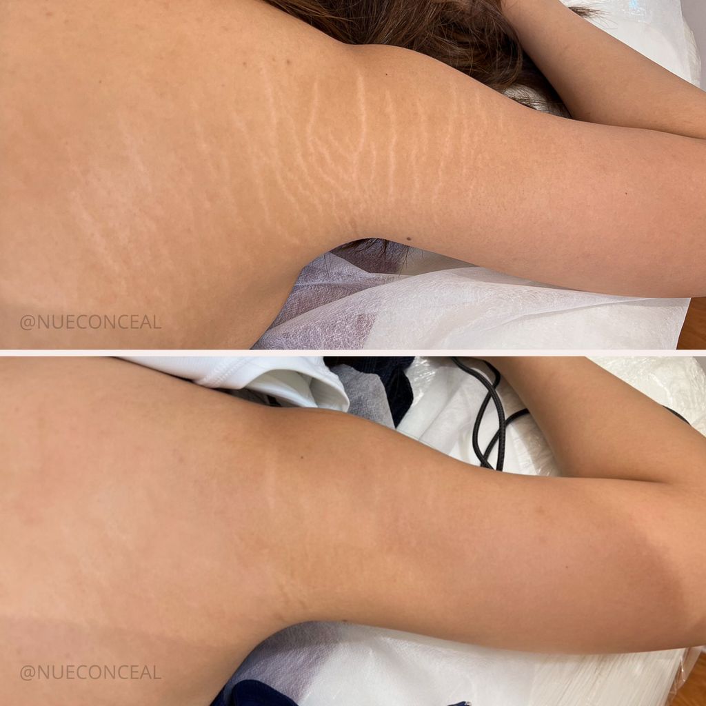 Stretch marks before and after