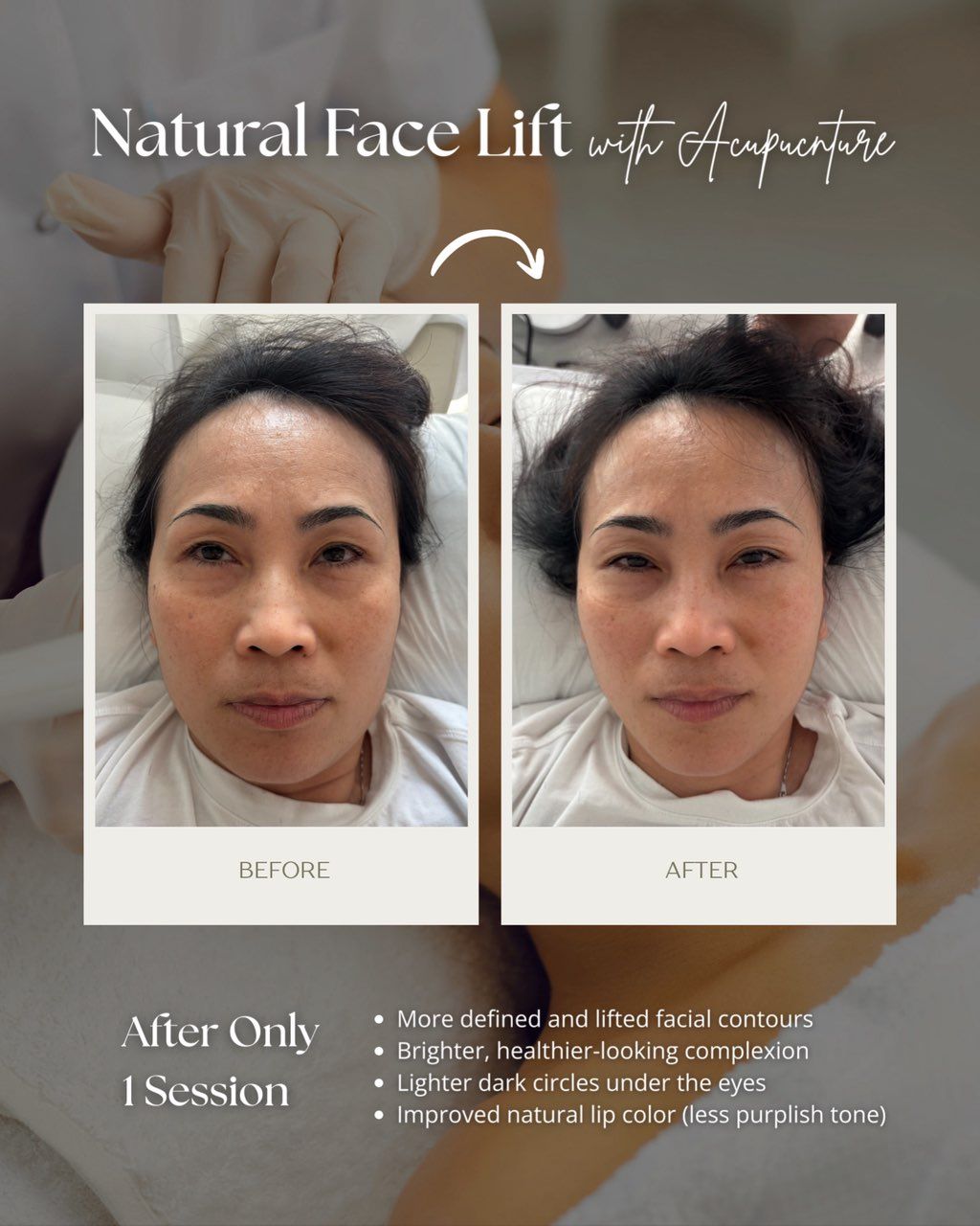 All natural cosmetic facial acupuncture session✨