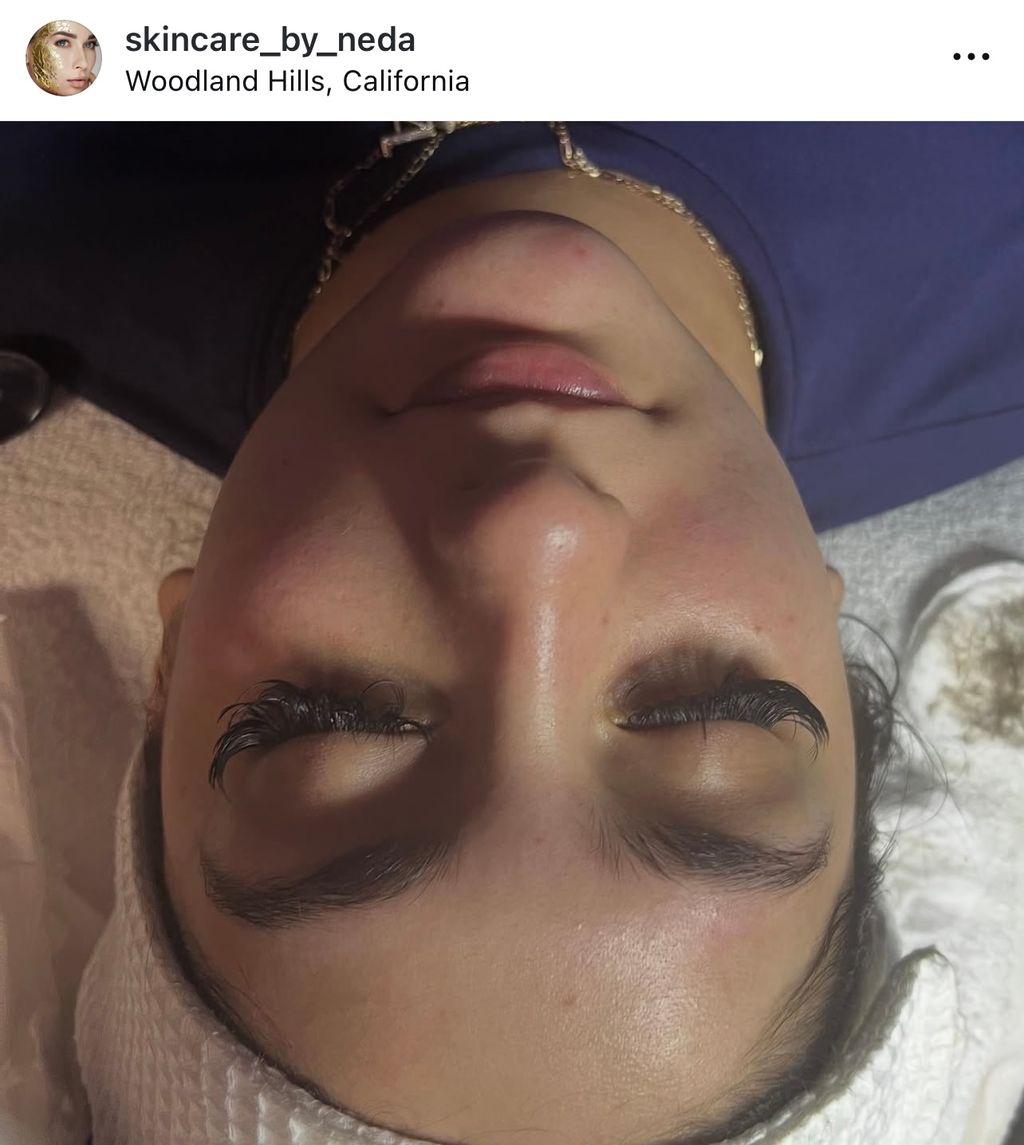 Dermaplaning is done to remove dead skin and peach
